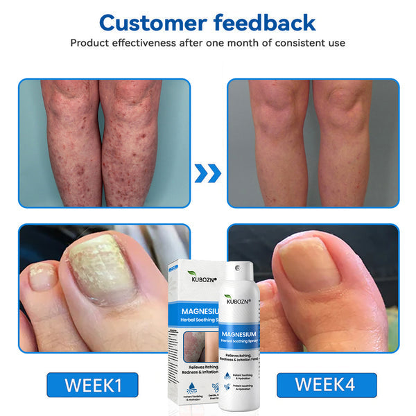 ✅ Official Store: KUBOZN® Magnesium Herbal Psoriasis Spray 👨‍⚕️ MHRA Approved (Relieves psoriasis and eczema, improves bacterial infections in the genital area, treats acne and warts)