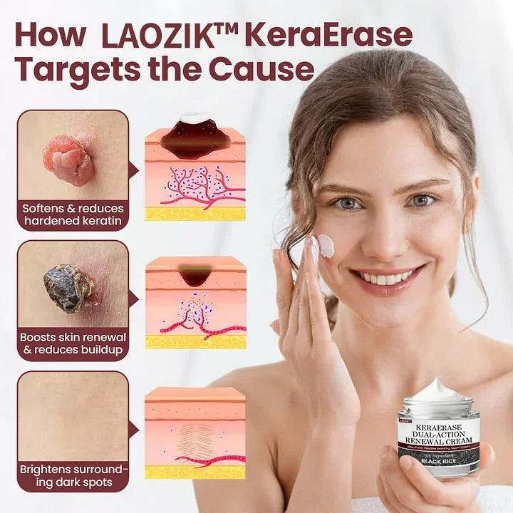 🔥Laozik®KeraErase Dual-Action Renewal Cream🔥The FDA-Approved Solution🌟 Official Store