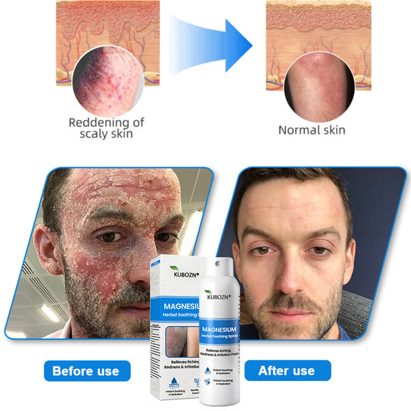 ✅ Official Store: KUBOZN® Magnesium Herbal Psoriasis Spray 👨‍⚕️ MHRA Approved (Relieves psoriasis and eczema, improves bacterial infections in the genital area, treats acne and warts)