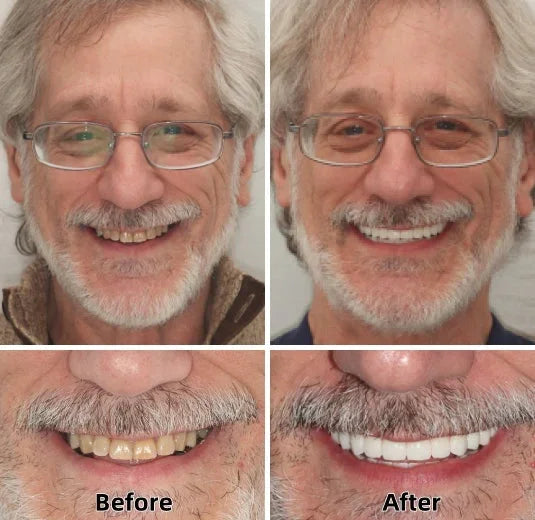 🦷💝LAOZIK™-Advanced Custom-Fit Functional Dentures👨‍⚕😁